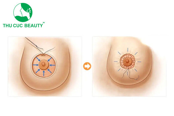 Thu nhỏ quầng vú giá bao nhiêu?