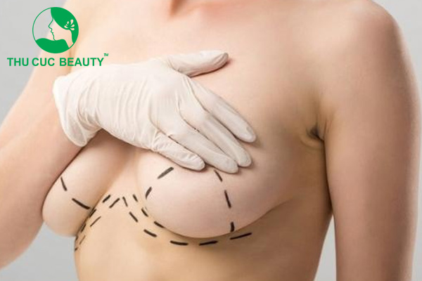 Treo ngực sa trễ không đặt túi 