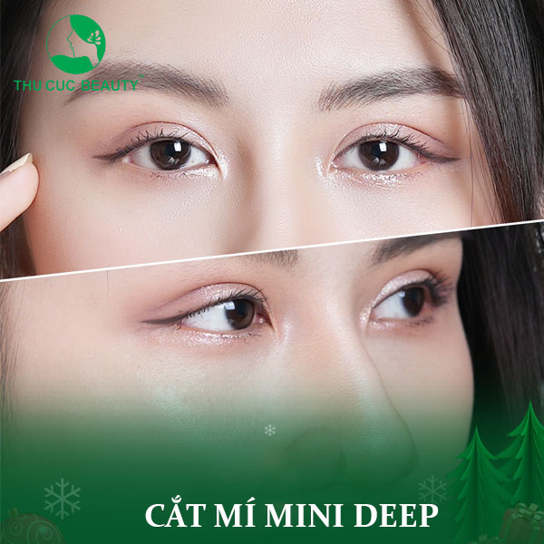Cắt mí Mini Deep làm một lần, đẹp dài lâu