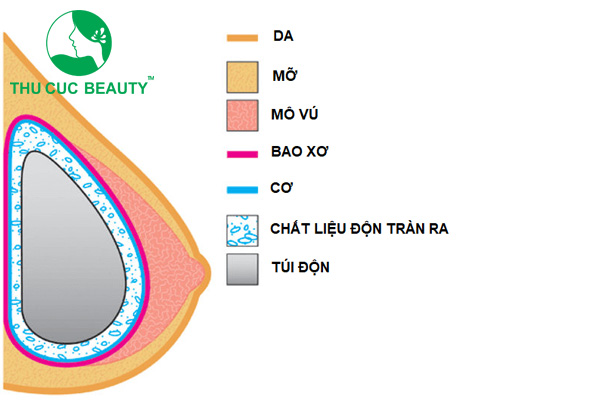 Nâng ngực bị bao xơ 