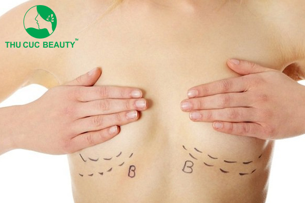 Giải đáp: Nâng ngực rạch ở đâu?