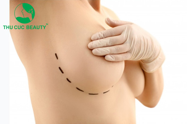 Phẫu thuật cắt ngực có nguy hiểm không?