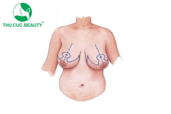 Phì đại tuyến vú: Cách nhận biết và phương pháp điều trị