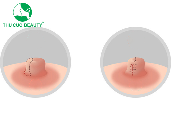 6 cách thu nhỏ nhũ hoa tại nhà đơn giản, dễ làm