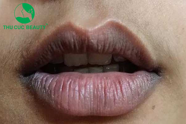 Nam giới môi thâm nguyên nhân do đâu? Cách khắc phục
