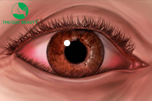 Cắt mắt bị lật mí trên: Nguyên nhân và cách xử lý