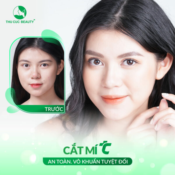 Cắt mí full và mini khác nhau như thế nào?