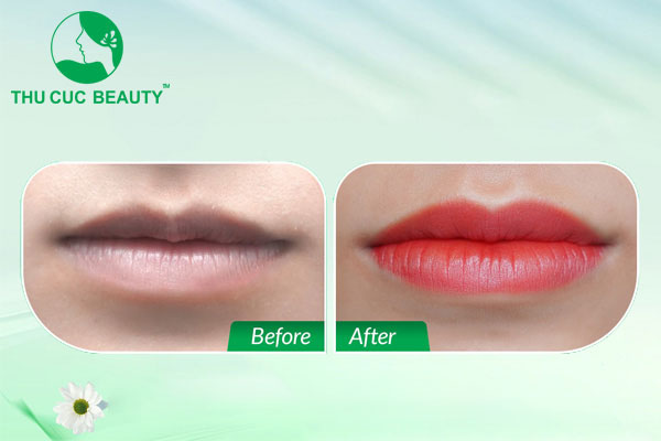 Khử thâm môi bao lâu thì bong? Bao lâu lên màu đẹp?