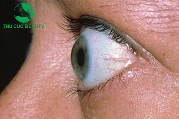 Mắt ốc nhồi là gì? Cách khắc phục tình trạng mắt ốc nhồi