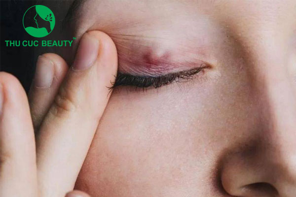 Nhấn mí bị nổi cục: Nguyên nhân và cách khắc phục