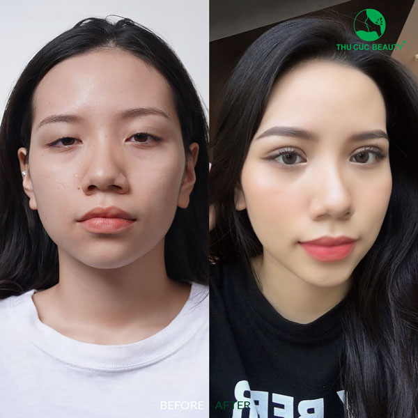 Nhấn mí giá bao nhiêu? Bảng giá nhấn mí tại Thu Cúc