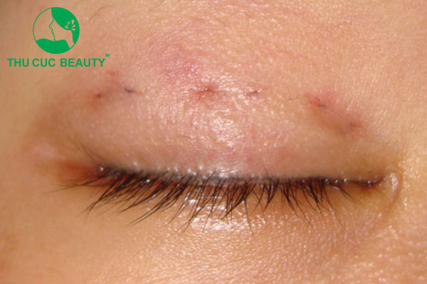 Nhấn mí hỏng xử lý như thế nào?