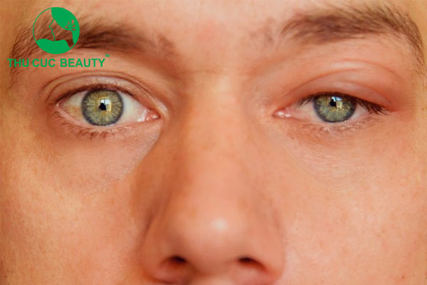 Sụp mí 1 bên và cách điều trị hiệu quả