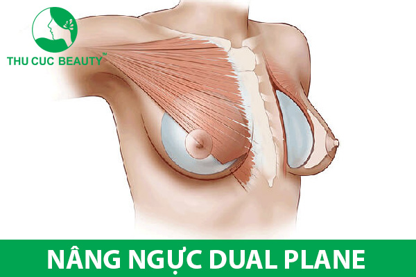 Nâng ngực dual plane và những điều cần biết