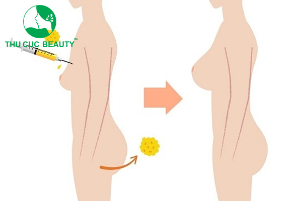 Nâng ngực tế bào gốc và lưu ý khi thực hiện