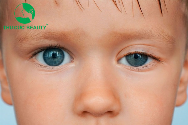 Sụp mí bẩm sinh và những điều cần chú ý
