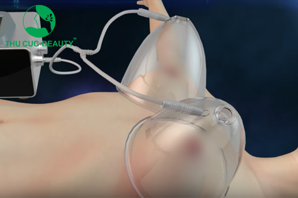 Cảnh báo: Nâng ngực bằng máy hút chân không 