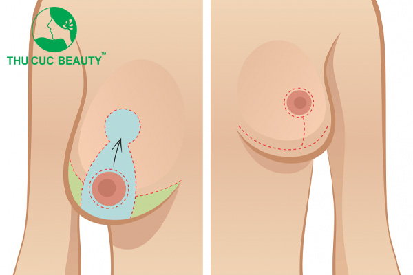 Treo ngực sa trễ đường mỏ neo