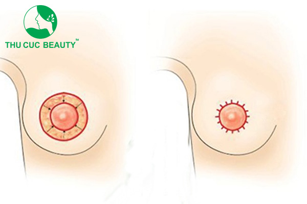 Treo ngực sa trễ đường quầng