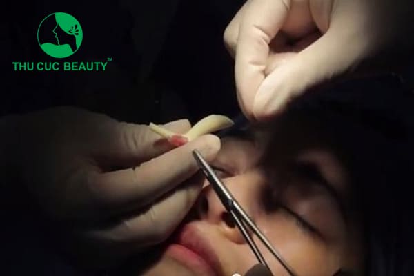 Tháo sụn mũi bao lâu thì lành?