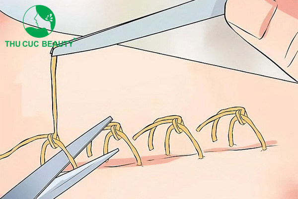 Cắt chỉ nâng mũi có đau không? Bao lâu thì cắt chỉ?