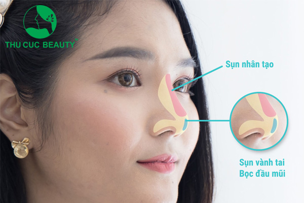 Nâng mũi bao lâu thì gom lại?