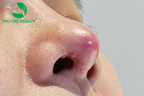 Nâng mũi bị dị ứng sụn: 5 dấu hiệu và 4 cách phòng tránh