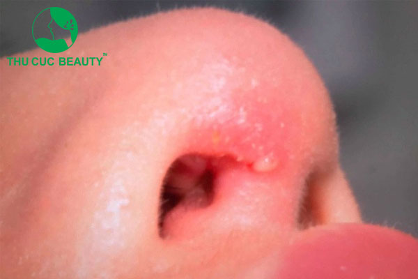 Nâng mũi bị hở vết thương xử lý thế nào?