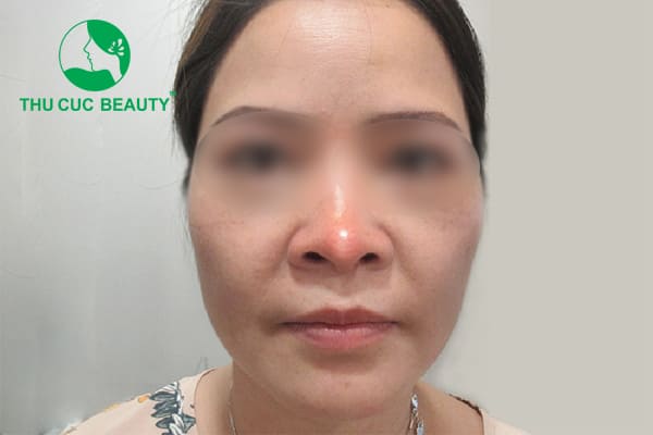 Nâng mũi lần 2 có đau không?