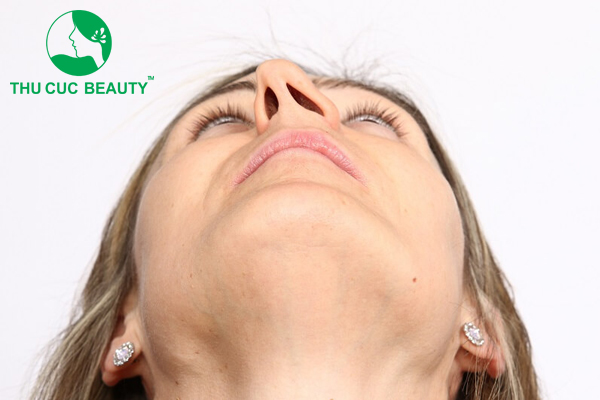 Nâng mũi lần 2 và những điều cần chú ý