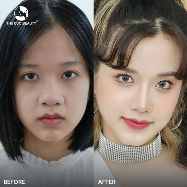 Nâng mũi ở Nhật Bản có đáng hay không?