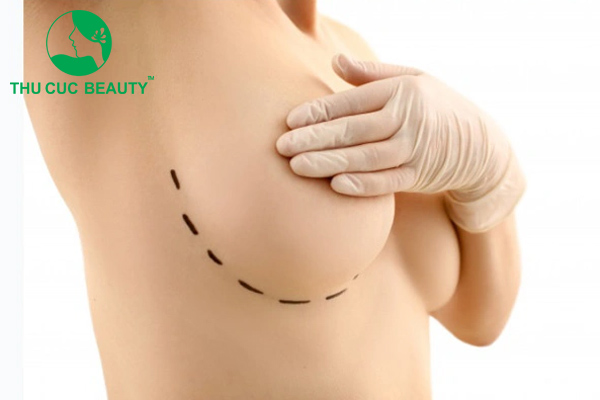 Nâng ngực xong có bị xệ không?