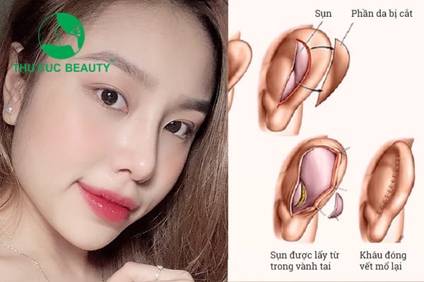 Điểm danh 4 tác hại của nâng mũi bằng sụn tai