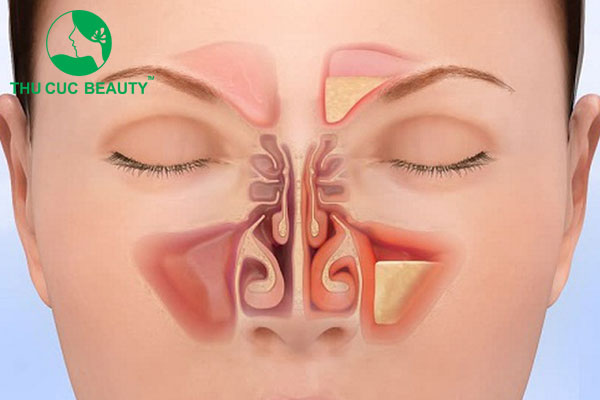 Viêm xoang có nâng mũi được không?