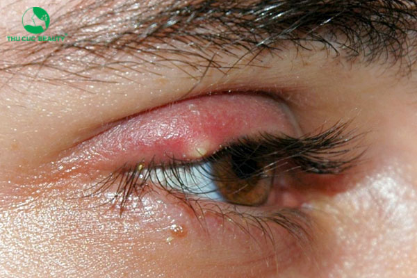 nhiễm trùng mắt
