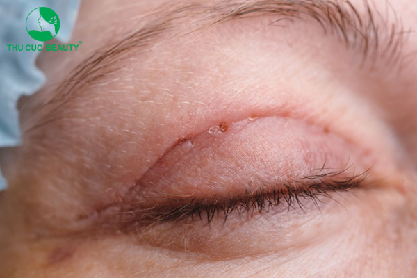 Chỉ nhấn mí có tự tiêu không? Sau bao lâu thì tiêu chỉ?