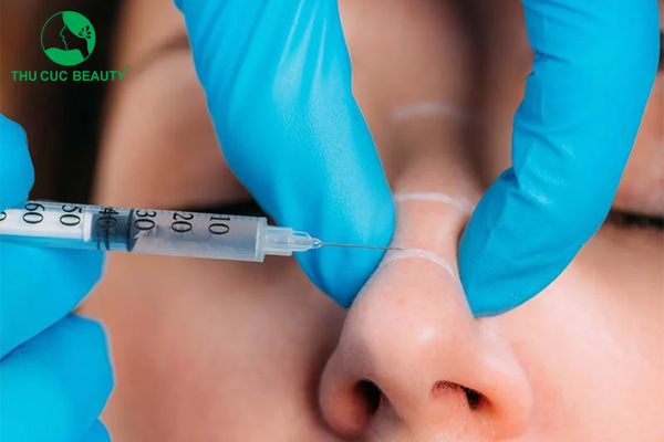 Nâng mũi bằng mỡ tự thân là gì? Giữ được bao lâu? Giá bao nhiêu