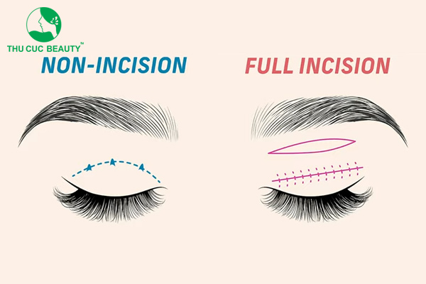 Cắt mí rồi có nhấn mí được không?