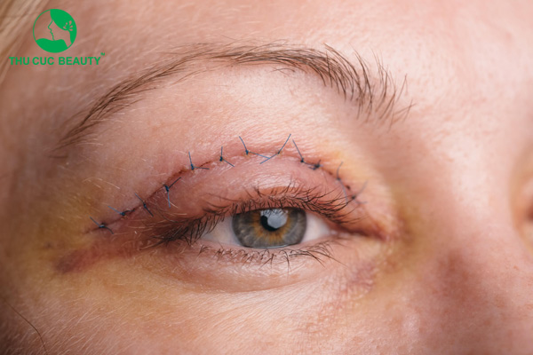 Mắt 2 mí có nên nhấn mí không?