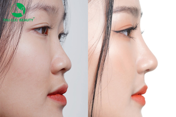 Nâng mũi bao lâu thì lành và vào nếp đẹp tự nhiên?