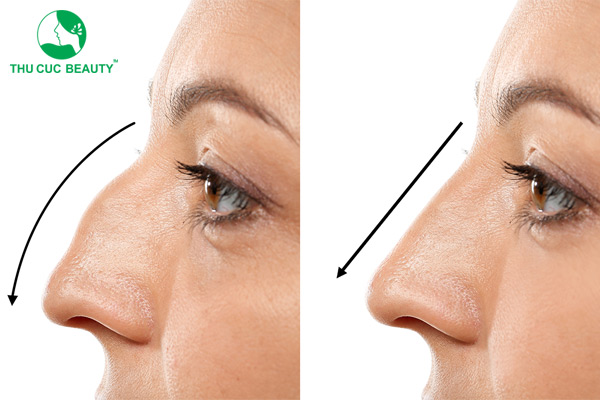 Nâng mũi khi về già và những điều cần cân nhắc