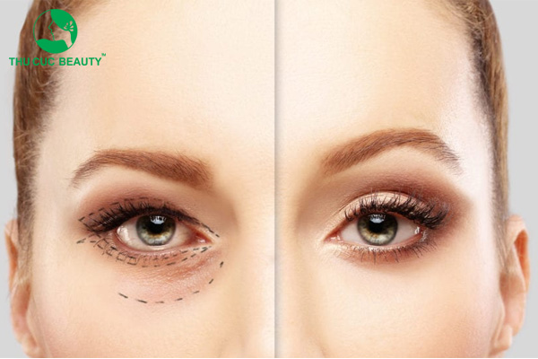 Nhấn mí bao lâu thì đẹp? Yếu tố ảnh hưởng quá trình vào nếp