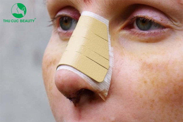 Tất tần tật về những hiện tượng sau khi nâng mũi