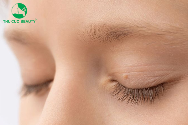 Tháo chỉ nhấn mí bao lâu thì lành?