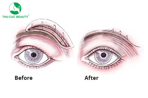 Treo chân mày bao lâu thì lành?