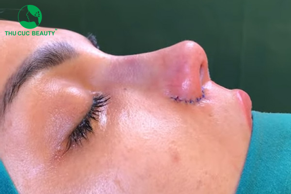 4 biến chứng thu gọn cánh mũi thường gặp