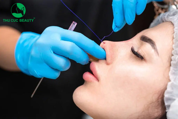 Chi phí nâng mũi bằng chỉ giá bao nhiêu tiền?