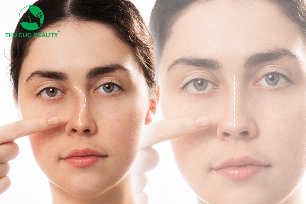 Nâng mũi cấu trúc có bị lệch không? Lưu ý để có dáng mũi cân đối