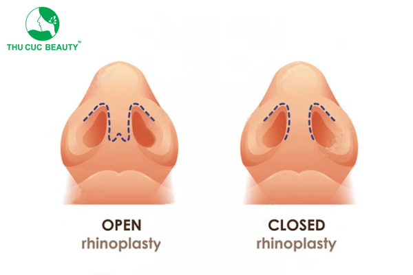 Nâng mũi mổ kín hay hở? Nên lựa chọn phương pháp nào?