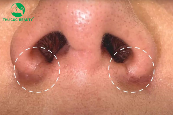 Thu gọn cánh mũi có mất lộc, phá tướng không?